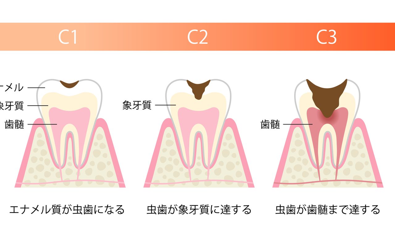 虫歯